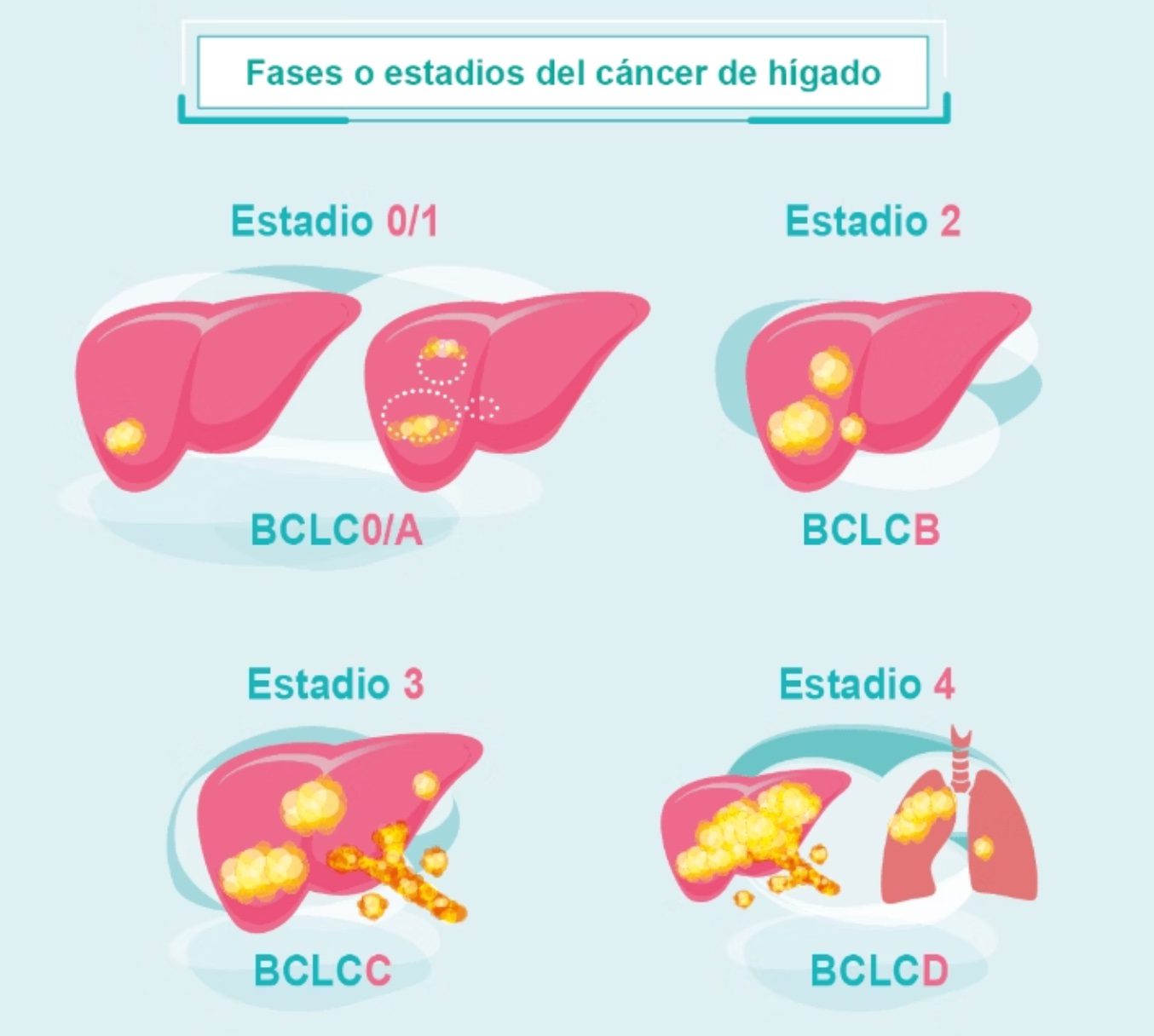 etapas cancer higado