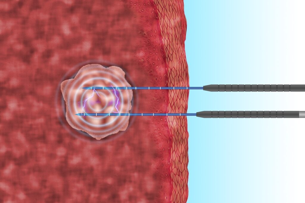 electroporacion irreversible