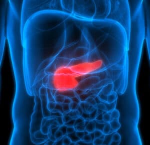 cancer de pancreas