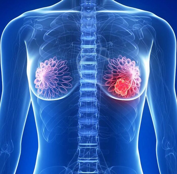 cáncer de mamas causas