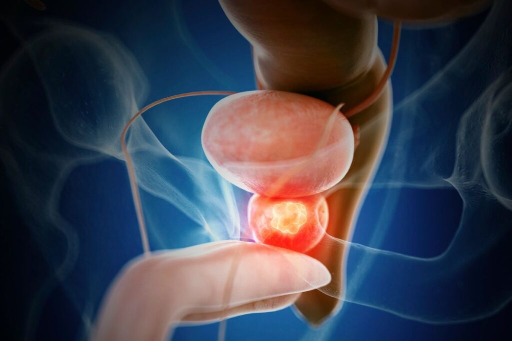 Qué causa el cáncer de próstata