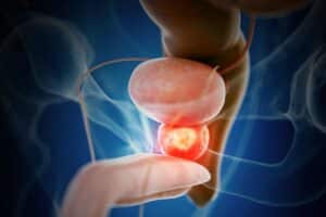 Qué causa el cáncer de próstata