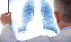 Datos sobre el cáncer de pulmón en México