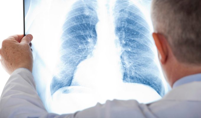 Datos sobre el cáncer de pulmón en México