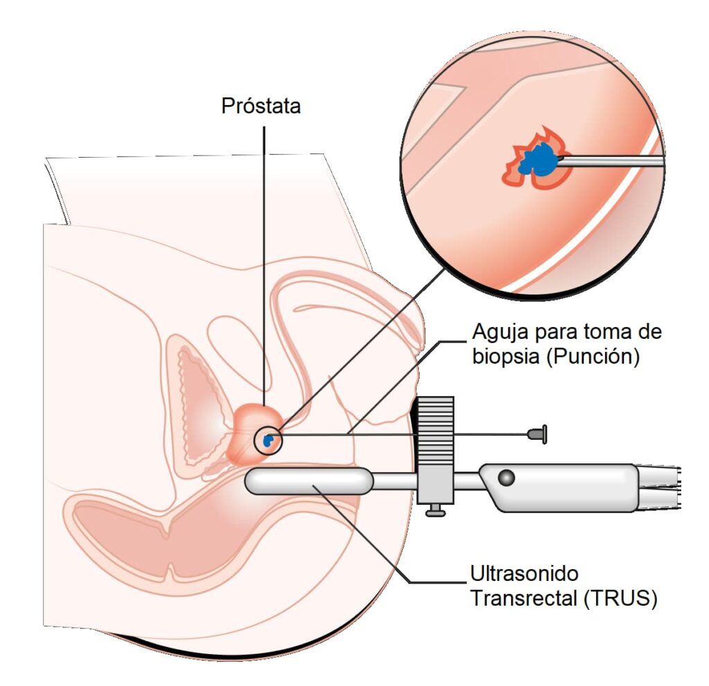 Biopsia de próstata por fusión de imágenes