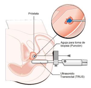 Biopsia de próstata por fusión de imágenes