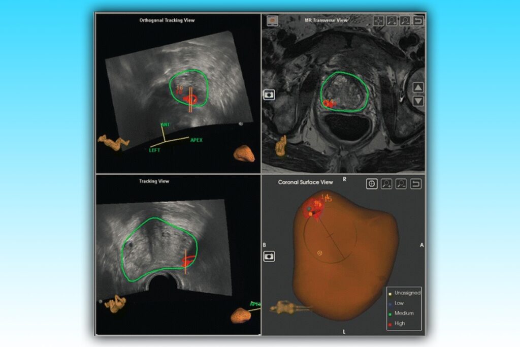 biopsia de próstata pro fusión de imagenes