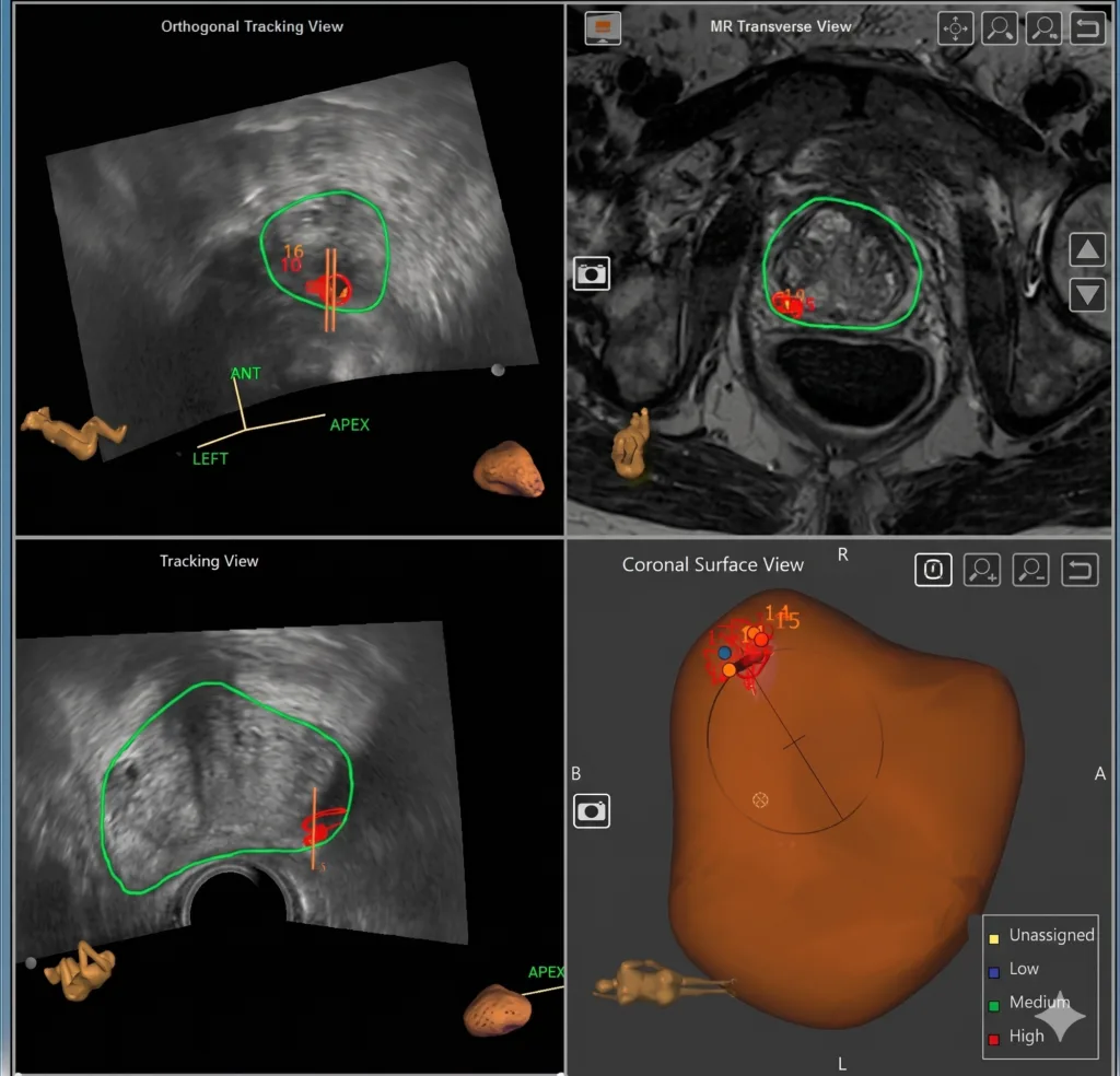 cáncer próstata navegación robotica