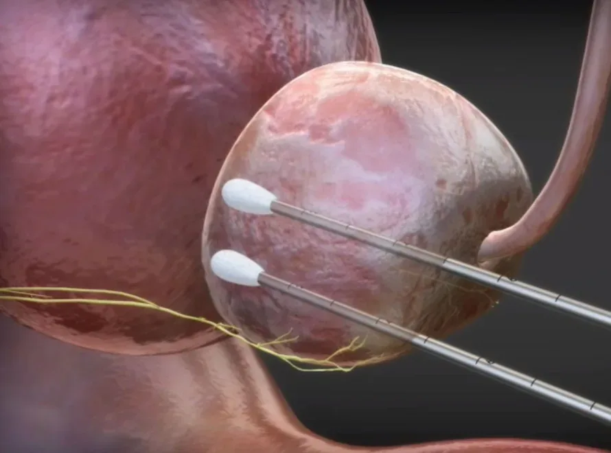 crioablacion cancer prostata beneficios