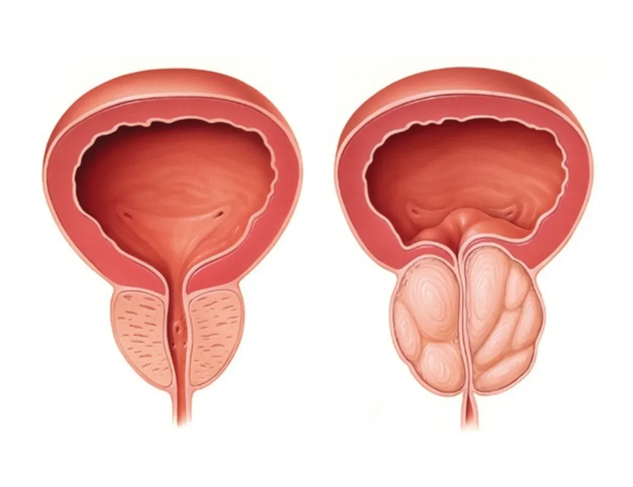 diferencias entre cáncer de próstata e hiperplasia benigna