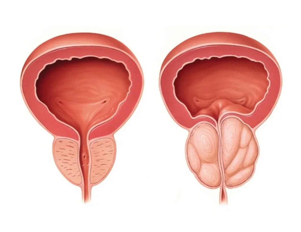 diferencias entre cáncer de próstata e hiperplasia benigna