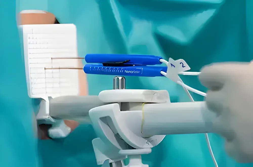 electroporacion irrebersible cancer prostata alternativa tratamiento