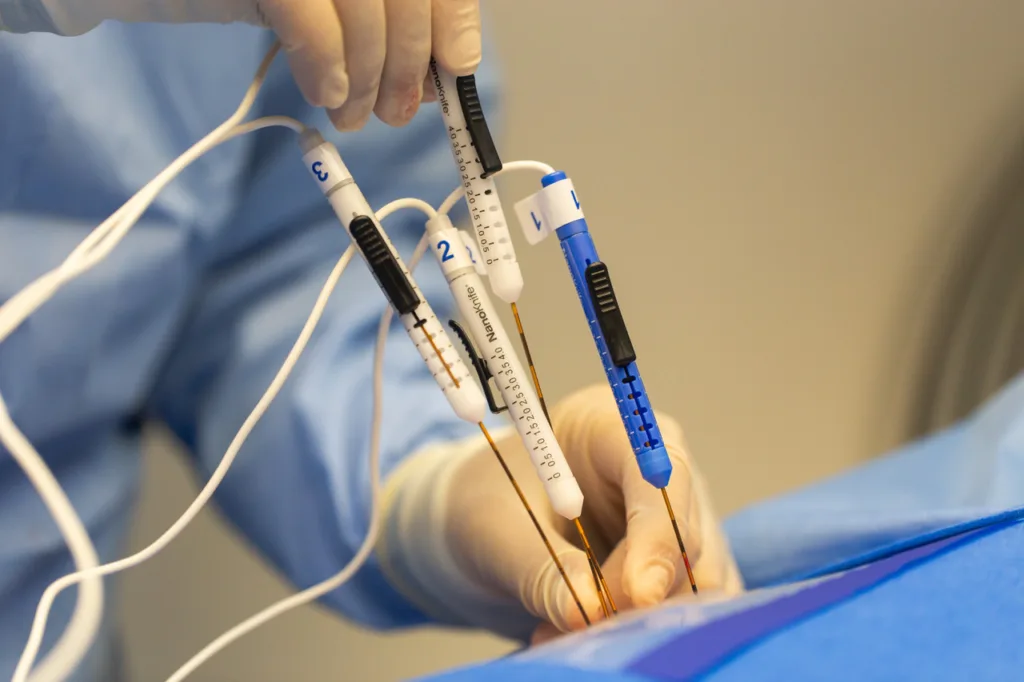 electroporacion irreversible para cancer de pancreas