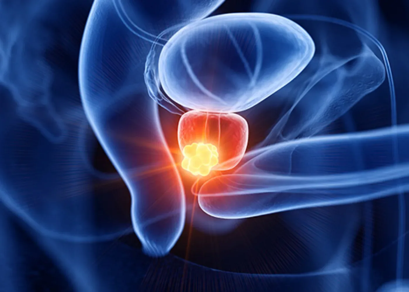 terapia focal en cáncer de próstata